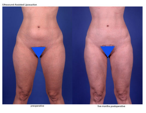 ual-abd_hips_thighs_anterior </p>