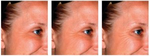 Merz-Scales-quantify-facial-aging