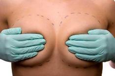 Breast Augmentation