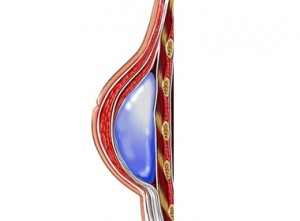 breast recon
