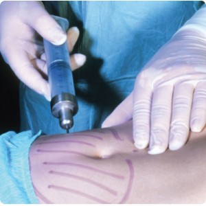 liposuction_photorsrchrs
