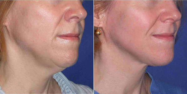 Liposuction-with-thermage