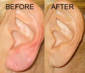 earlobeS