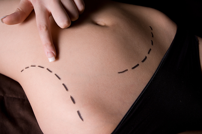 liposuction technique Liposuction