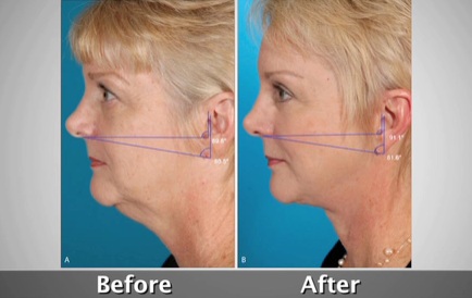 Facelift before and after Facelift-before-and-after