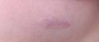 plastic surgery scar therapy