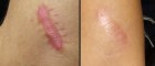 scars scars