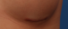 Scar4-cropped Scar4-cropped