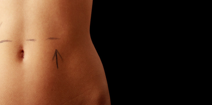 Liposuction plastic surgery
