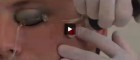 Skin Resurfacing Made Easier with Fractional Lasers | Plastic Surgery Channel Skin Resurfacing Made Easier with Fractional Lasers | Plastic Surgery Channel