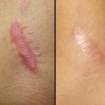 Treating Scars with Lasers