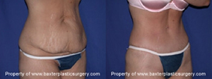 Tummy Tuck Procedure